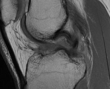 ACL PCL MRI